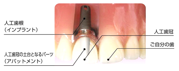 インプラント治療の図