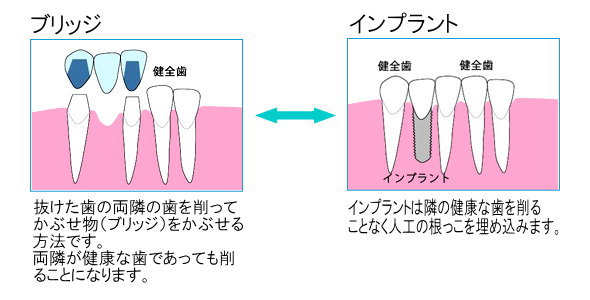 インプラント治療の比較