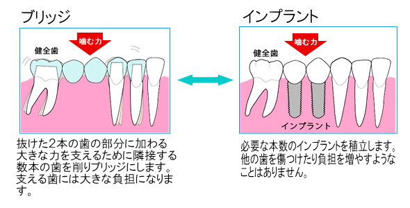 歯が抜けた場合