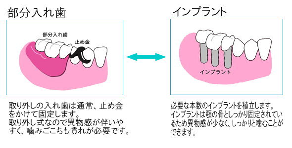 奥歯が抜けた