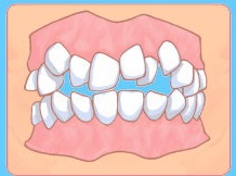 矯正治療・がたがたの歯並び