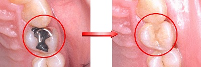 ハイブリッドセラミックによる歯科治療