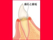 歯肉炎の図